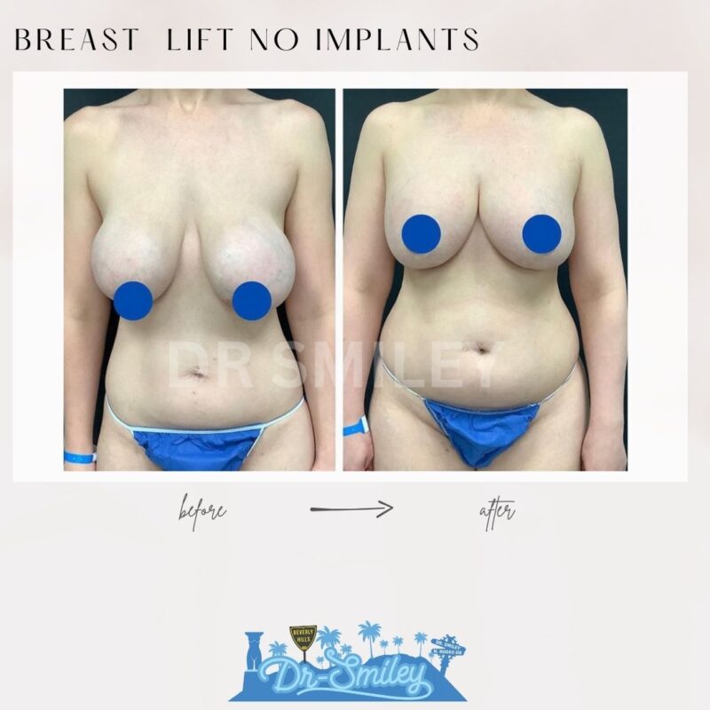 dr smiley top plastic surgeon breast lift beverly hills los angeles california 8