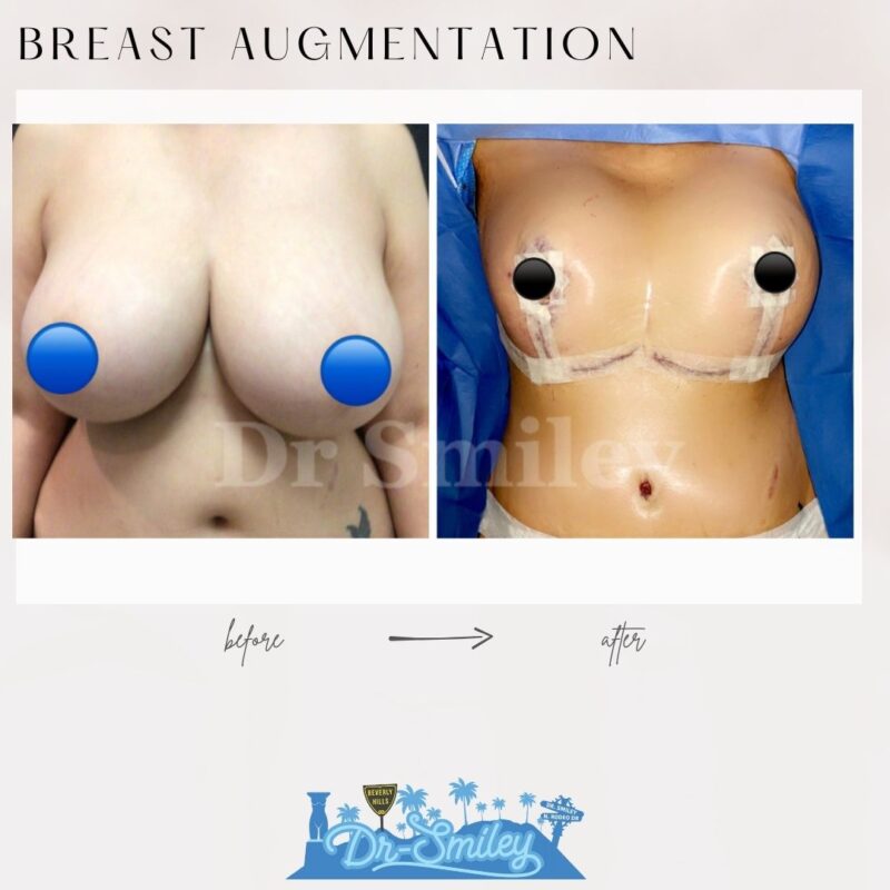 dr smiley top plastic surgeon breast lift beverly hills los angeles california 9