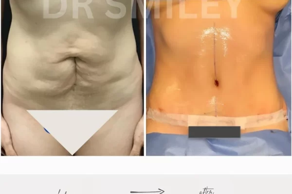 Tummy Tuck Cost Near Me In Beverly Hills