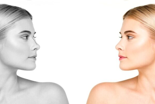 What Is Open Rhinoplasty - Procedure, Benefits, Before and After