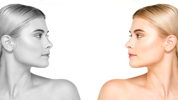 What Is Open Rhinoplasty? Know All About It