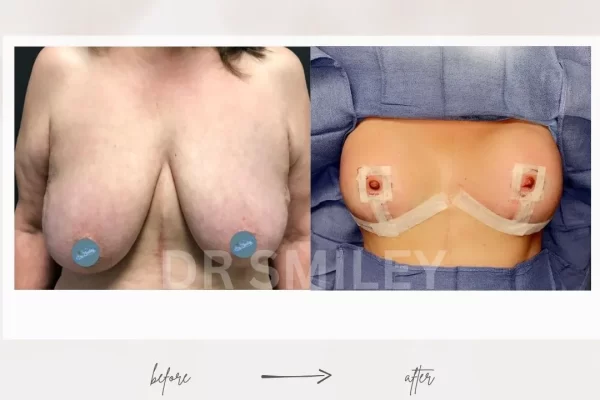 breast augmentation with fat transfer pros and cons