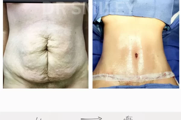 cost of tummy tuck near me