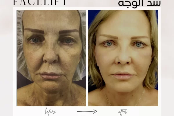 facelift surgery