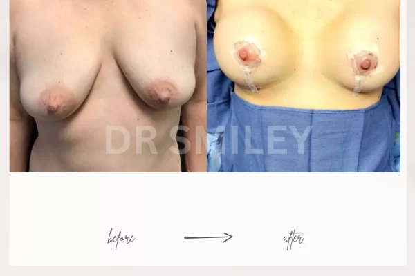 fat transfer to breast before and after