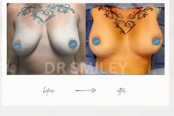 fat transfer to breast before and after