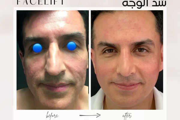 how long does facelift result last