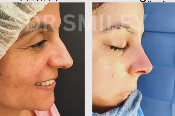 rhinoplasty in beverly hills