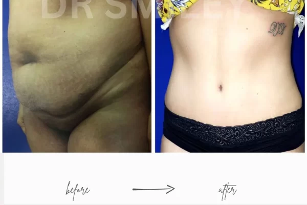 low tummy tuck cost near me