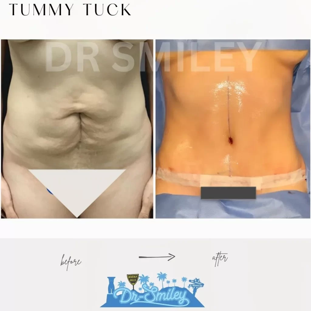 Tummy Tuck Before and After Photos - Real Patient Transformations