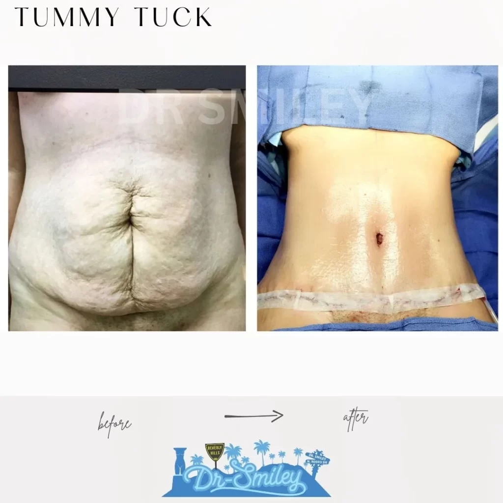 tummy tuck surgery before and after patient