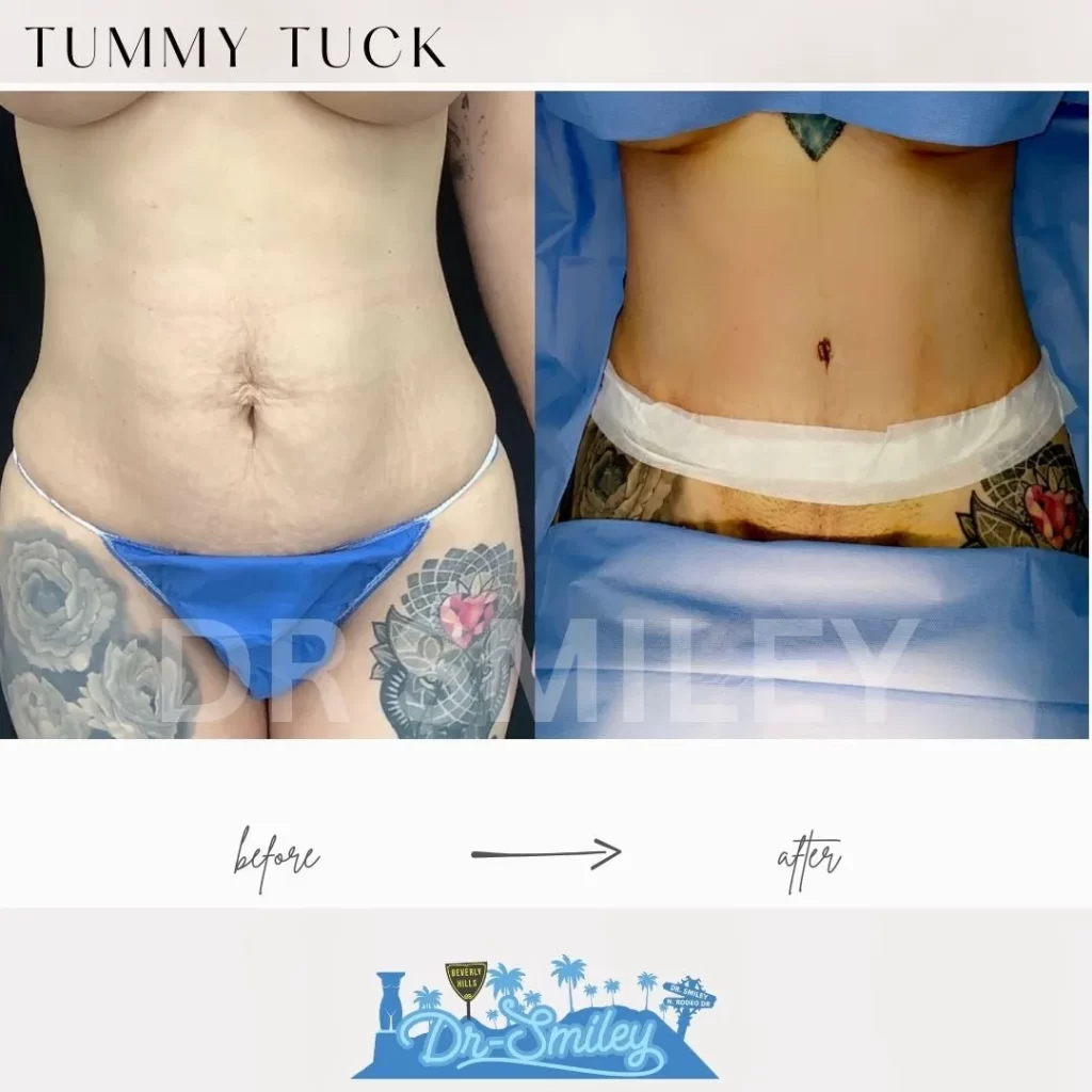 tummy tuck before and after surgery photos