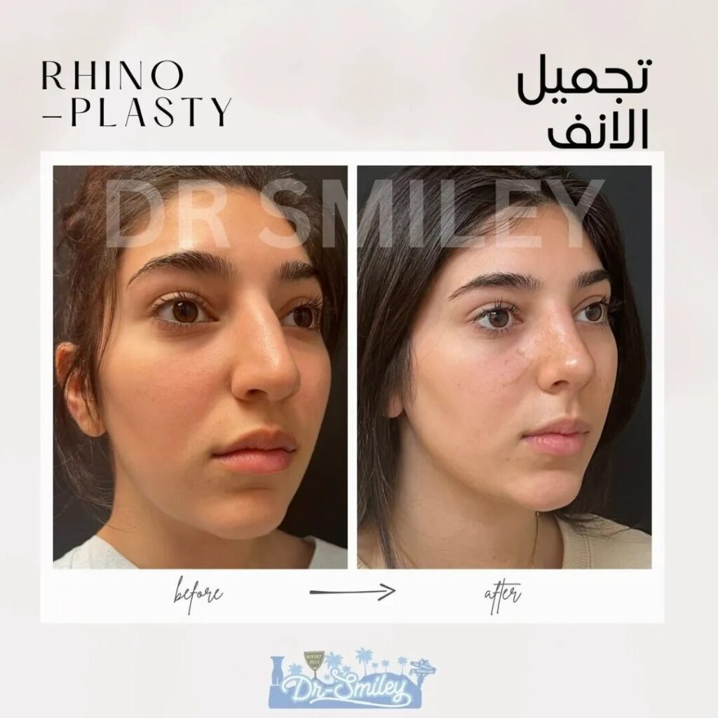 rhinoplasty results before and after