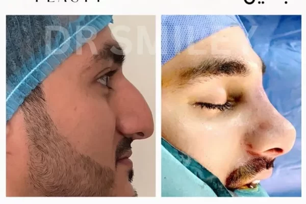 nose reshaping surgery before and after