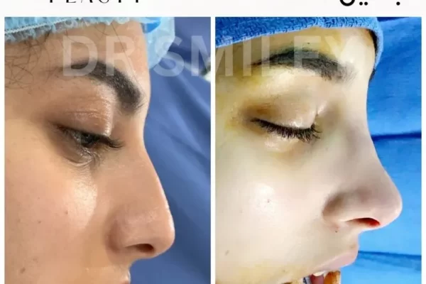 rhinoplaasty before and after