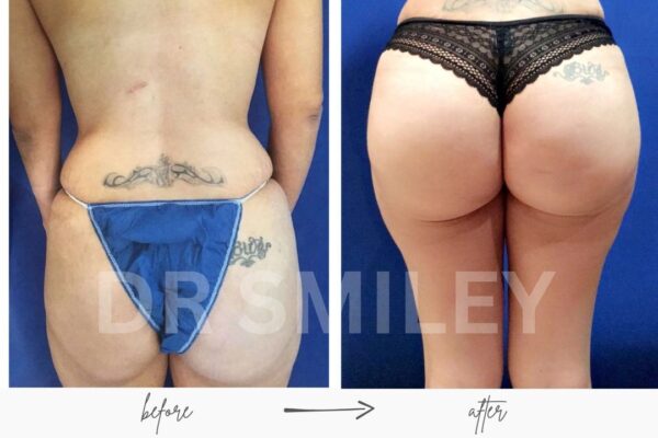 BRAZILIAN BUTT LIFT SURGERY