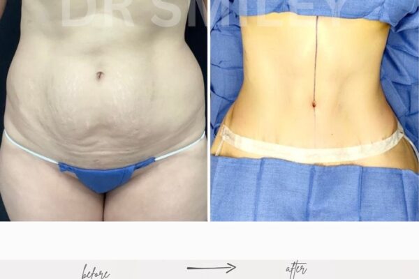 tummy tuck