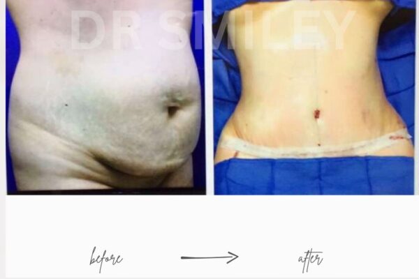 tummy tuck surgery