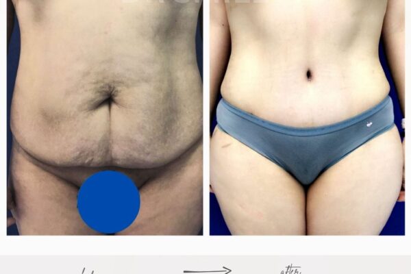 tummy tuck surgery before and after