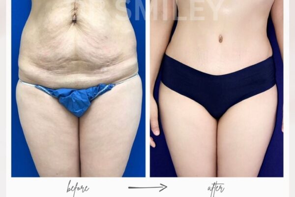 tummy tuck before and after