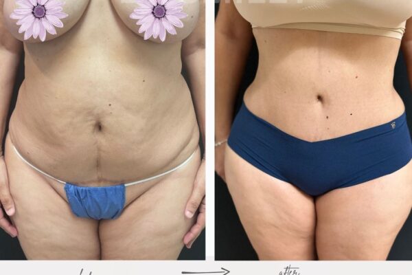 what are tummy tuck compression garments