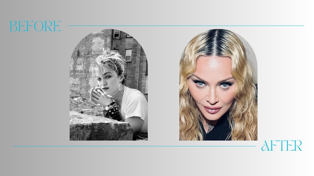 Madonna’s Plastic Surgery Journey: Before and After