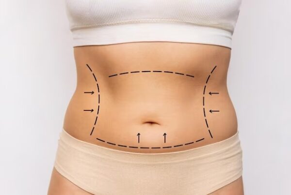 Liposuction 2.0 New Techniques Making Fat Removal Easier and Safer