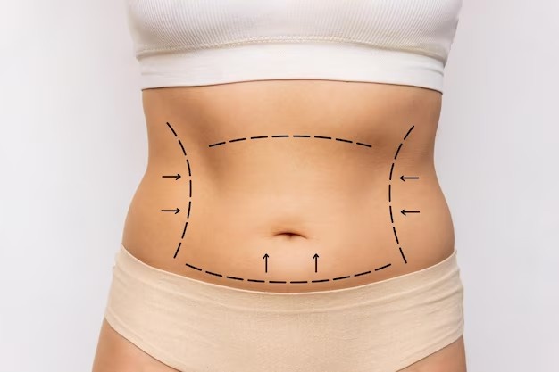 Liposuction 2.0: New Techniques Making Fat Removal Easier and Safer