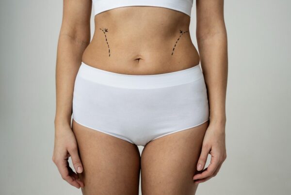Mini vs. Full Tummy Tuck Which One's Right for You