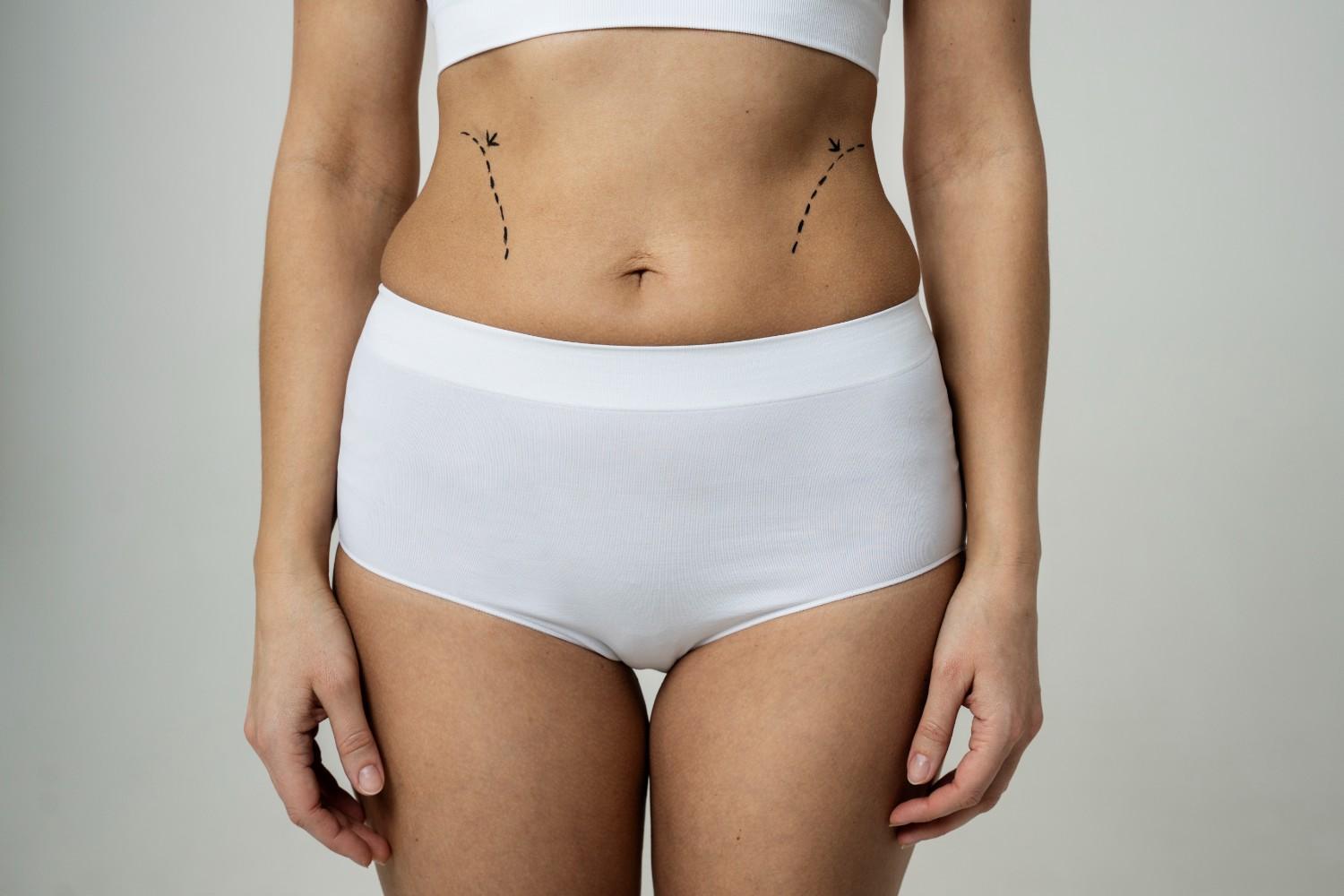 Mini vs. Full Tummy Tuck: Which One’s Right for You?